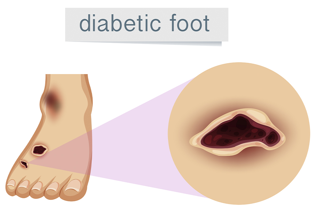 Pie diabético